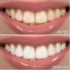 BLANQUEA-        MIENTO DENTAL